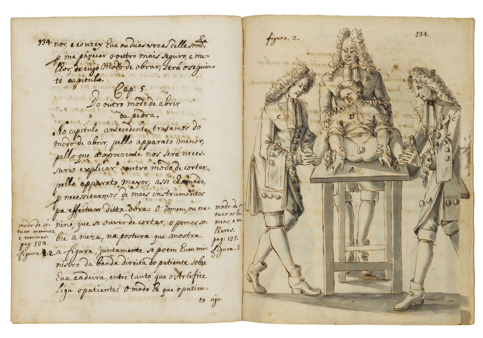 Surgical Illustration Facing-page manuscript with illustration on right page depicting individual lying on operating table with two men in curly wigs in coats and breeches holding down his wrists and feet and another with his hand on patient's shoulders; and left page with Portuguese text only.